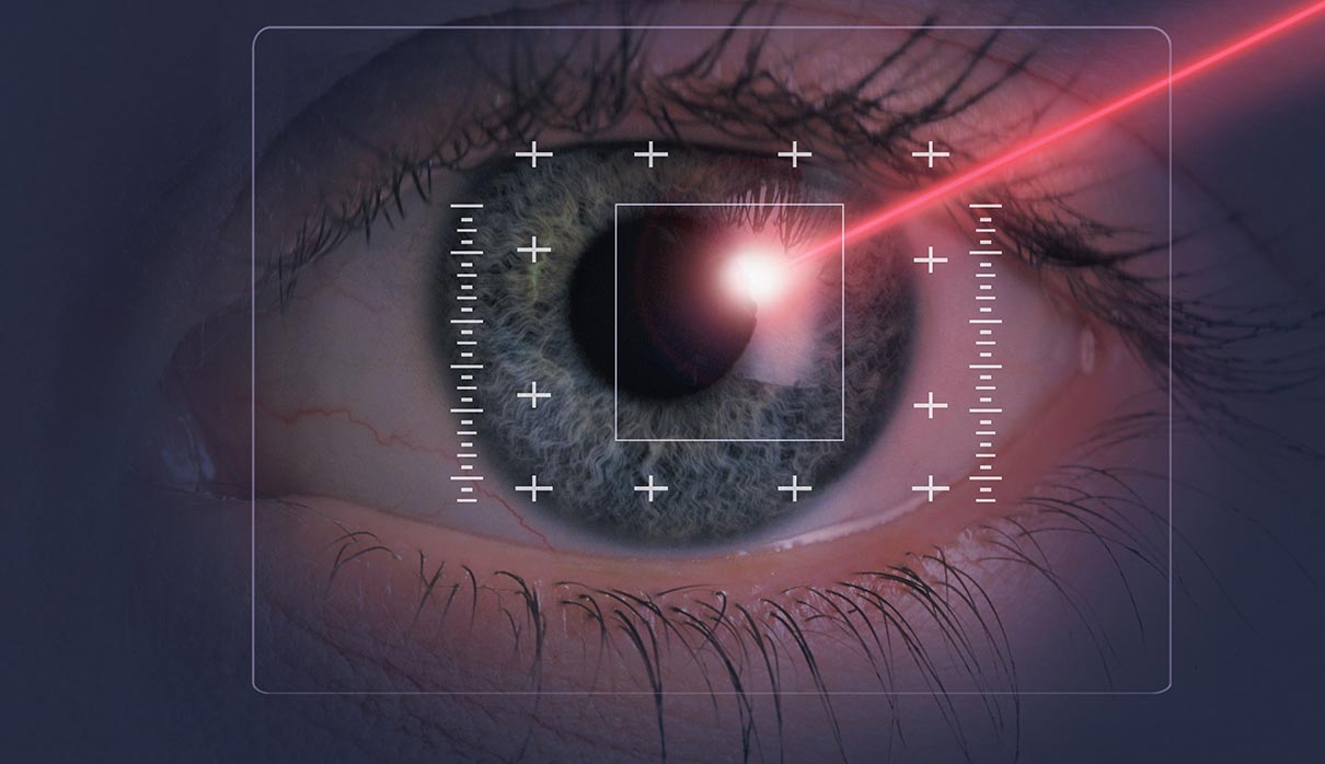 Excimer Laser (Refractive Surgery)