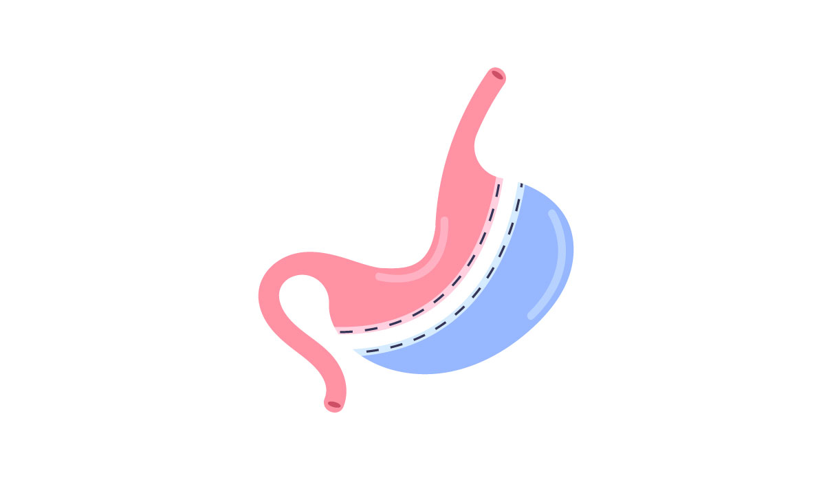 Gastric Sleeve